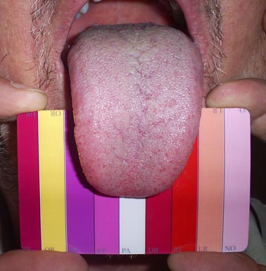 Tongue with DorisPlate